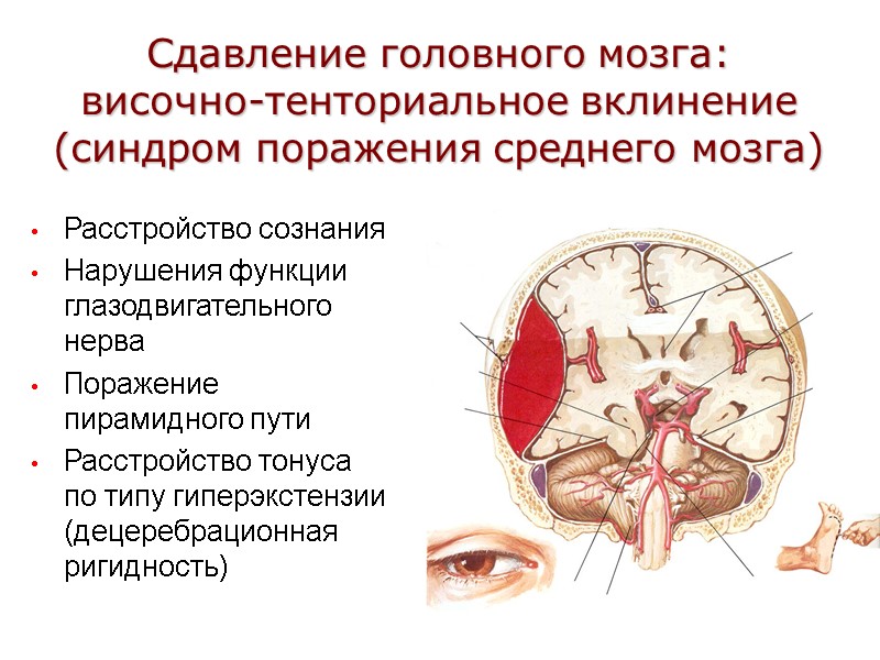 Сдавление головного мозга: височно-тенториальное вклинение (синдром поражения среднего мозга) Расстройство сознания Нарушения функции глазодвигательного